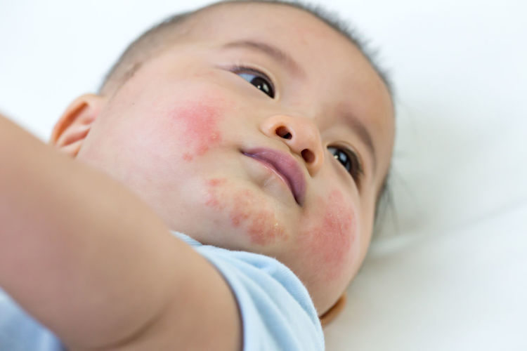 Close-up of cute baby boy with skin allergy lying on bed