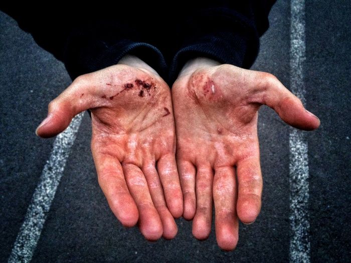 High angle view of injured cropped hands