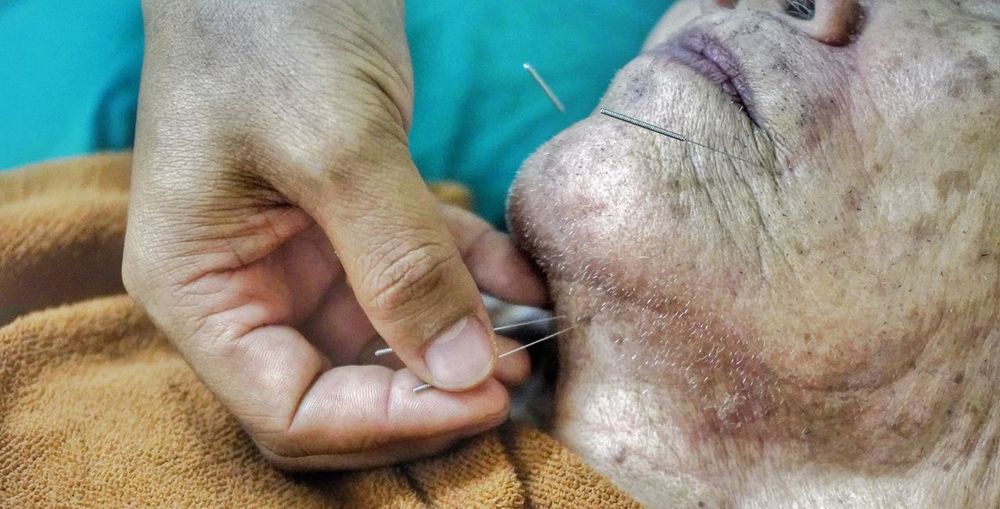 Close-up of human hands putting acupuncture needles in senior woman's face