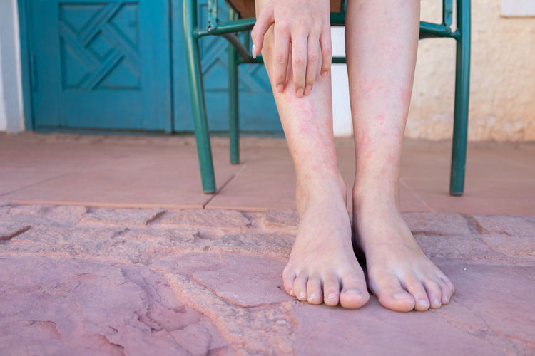 Girl's legs bitten by mosquitoes, close-up. woman scratching her feet bitten by insects.