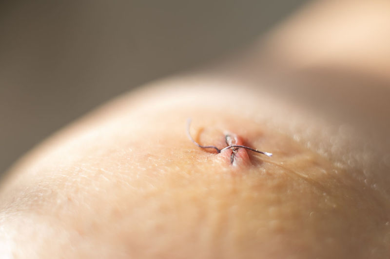 Close-up of sutures on skin