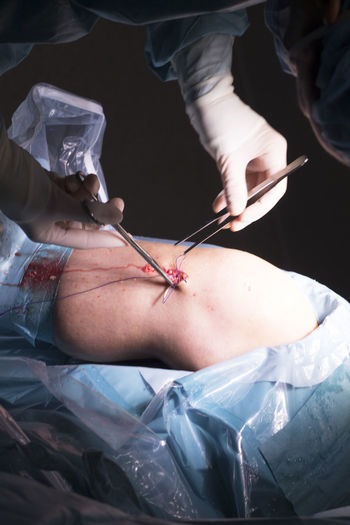 Midsection of surgeons doing knee surgery in hospital