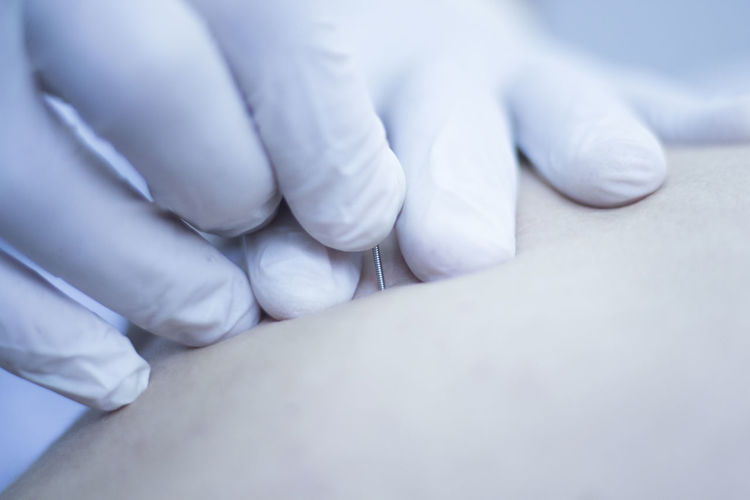 Cropped hands injecting acupuncture needle on patient skin