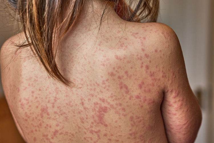 Severe back rash of a 5 year old girl due to antibiotics 