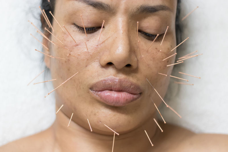 Close-up of acupuncture needles on woman face