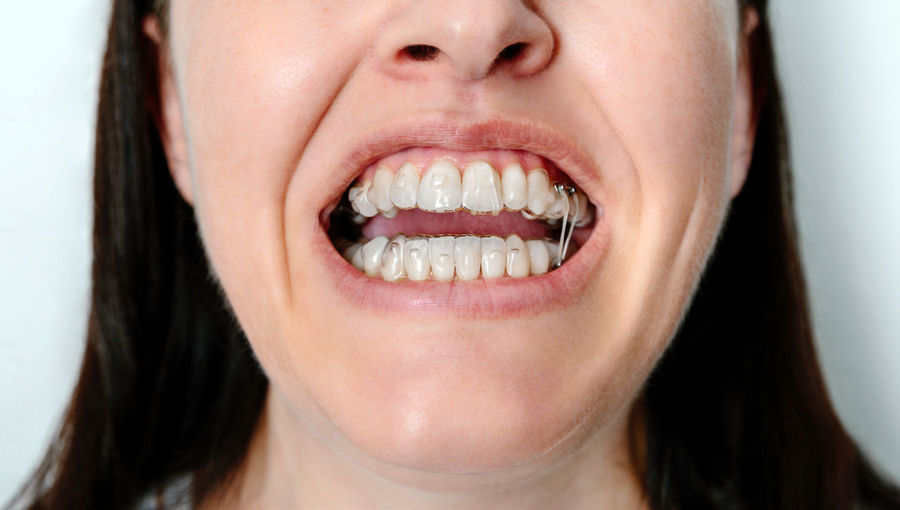 Woman with open mouth using orthodontic treatment with transparent removable aligners