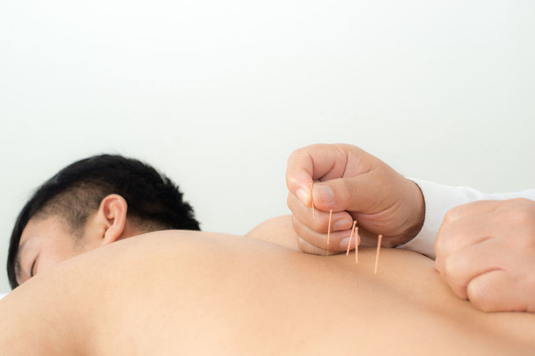 Shirtless man getting acupuncture treatment at hospital