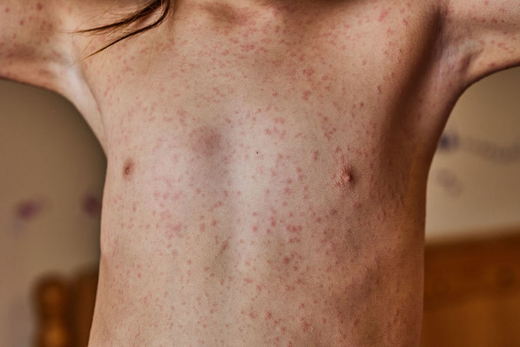 Allergic reaction to the antibiotic on a child's skin 