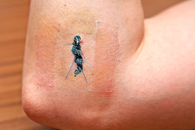 Cropped hand of person with injury