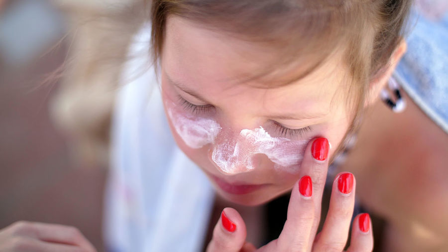 Girls, severe sunburn on the face. mom smears places of burns abundantly with a special cream.