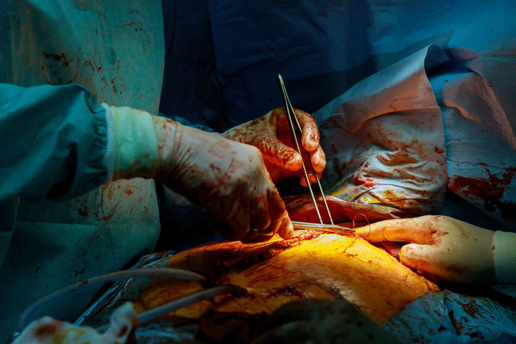 Midsection of surgeon operating patient at operation theatre